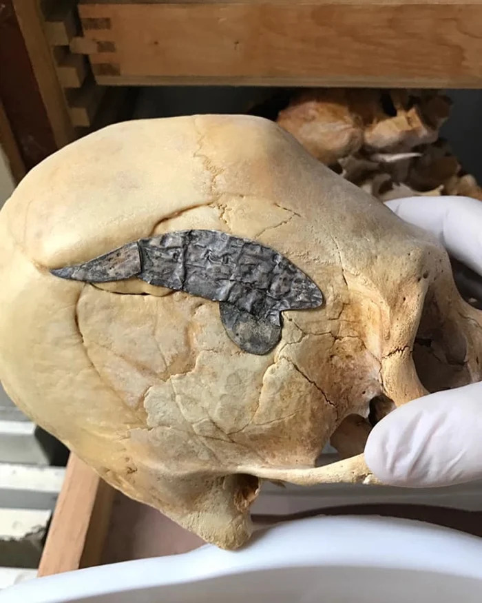 revistasaberesaude.com - Crânio de mais de 2 mil anos implantado com estranho objeto metálico divide especialistas