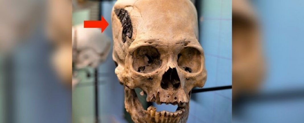 Crânio de mais de 2 mil anos implantado com estranho objeto metálico divide especialistas