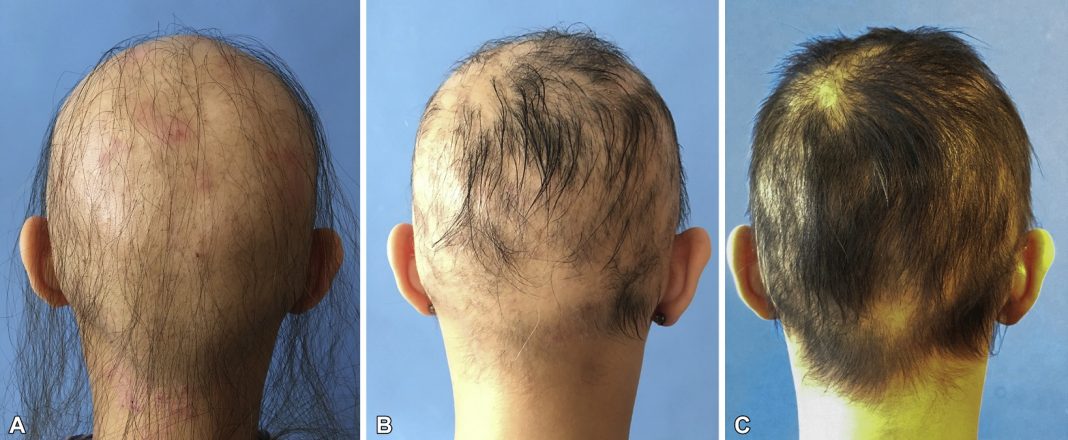 Medicamento comum para artrite oferece nova esperança para tratar alopecia grave