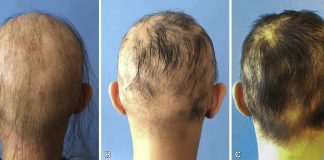 Medicamento comum para artrite oferece nova esperança para tratar alopecia grave