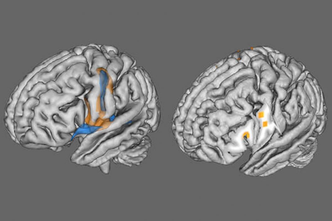Mesmo COVID ‘leve’ está ligado a mudanças cerebrais significativas, revela grande estudo