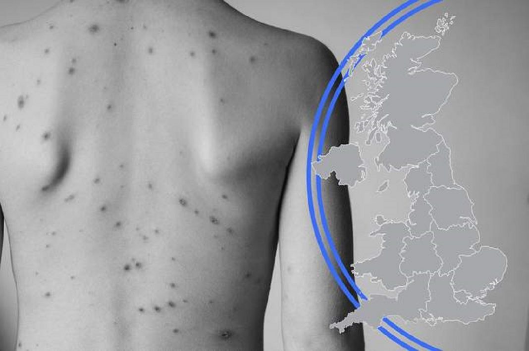 Surto raro de varíola no Reino Unido, Europa e EUA: o que é e devemos nos preocupar?