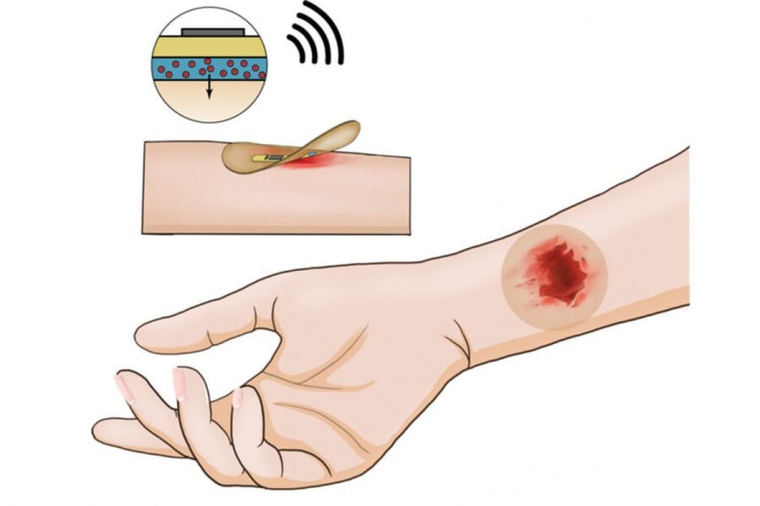 Bandagem inteligente monitora ferimentos em tempo real