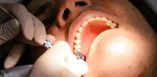 USP desenvolve hidrogel que ajuda a tratar erosão e sensibilidade dos dentes