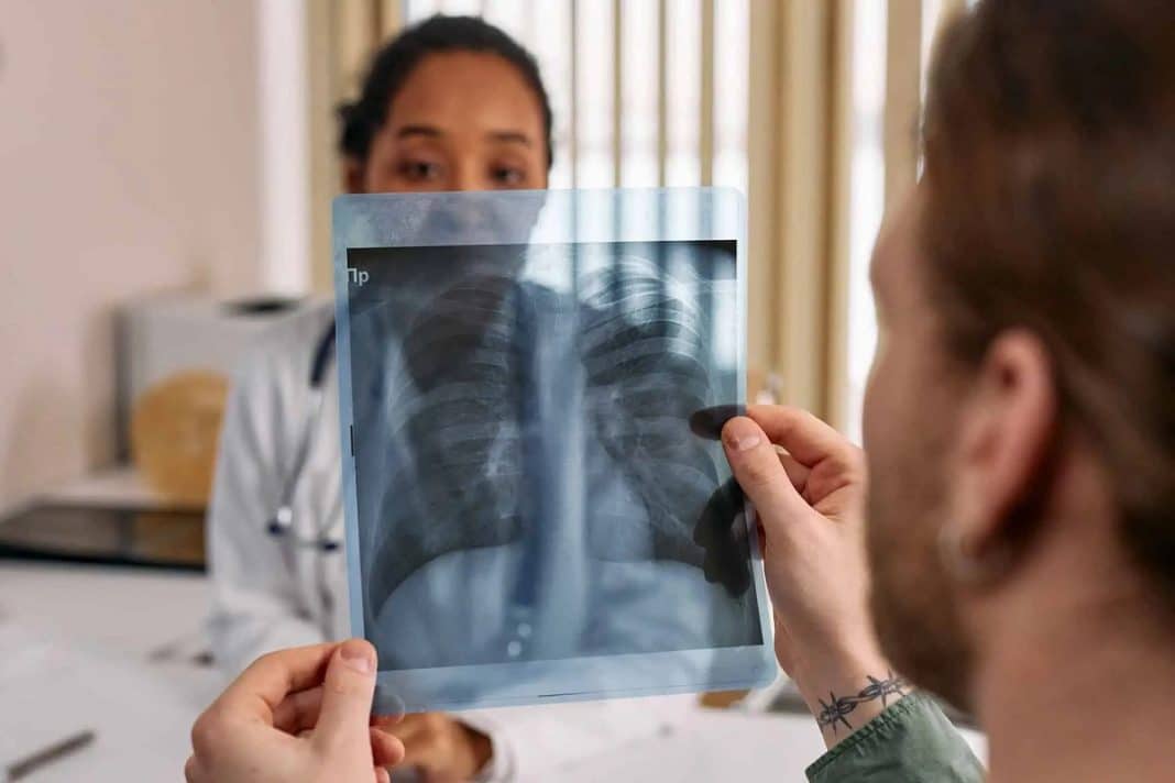 Esta IA pode salvar sua vida ao detectar o câncer de pulmão precocemente
